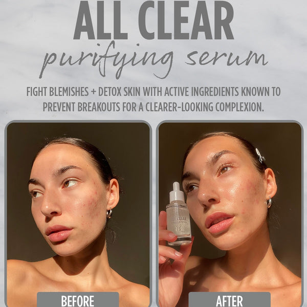 All Clear Purifying Serum, a ColourPop Face Serum, displayed in a side-by-side before-and-after; model holds a clear dropper bottle in the after shot with dewy, clearer-looking skin under warm light, highlighting blemish-targeting face serum results.